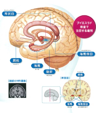 認知症検査（早期アルツハイマー病診断支援システム：VSRAD)